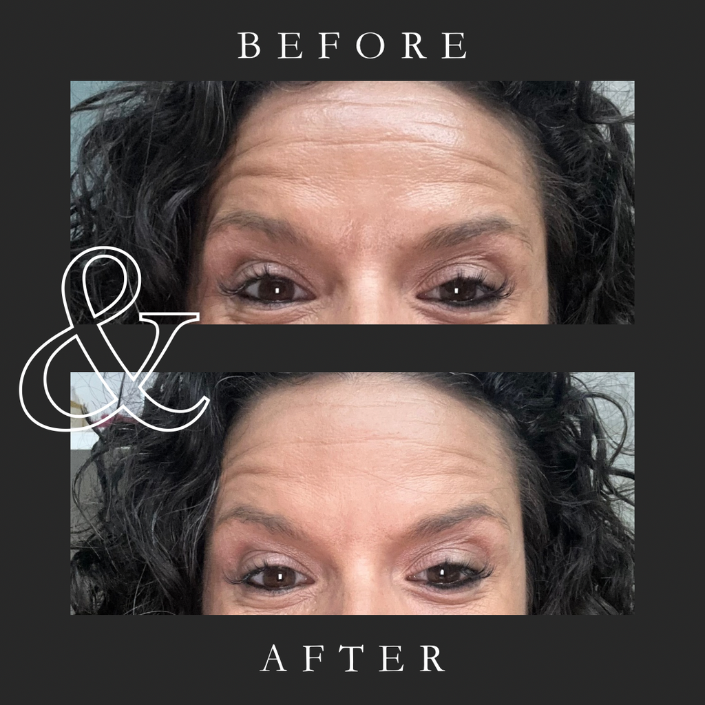 Liquid Botox Volu-Fill Deep Wrinkle Filler