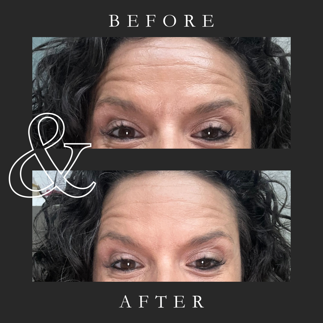 Liquid Botox Volu-Fill Deep Wrinkle Filler